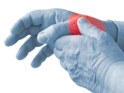 La rizoartrosi - o artrosi della mano - è una degenerazione articolare legata all'invecchiamento dei tessuti e colpisce l'articolazione che si trova alla base del primo dito, il pollice (articolazione trapezio-metacarpale). Questa degenerazione articolare, come tutte le forme di artrosi, tende a far assottigliare la cartilagine che riveste l'osso fino a farla scomparire del tutto. A quel punto, quando i monconi ossei contrapposti presenternno aree prive di cartilagine, farà la sua comparsa il dolore.