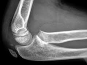 Frattura del capitello radiale