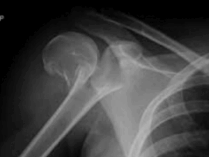 La frattura dell’omero