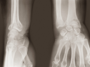 La frattura del metacarpo e della falange