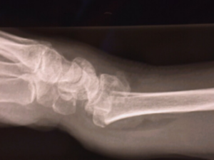 Frattura radio o del polso