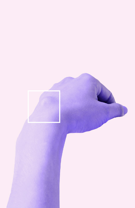 patologia mano cisti artrogena